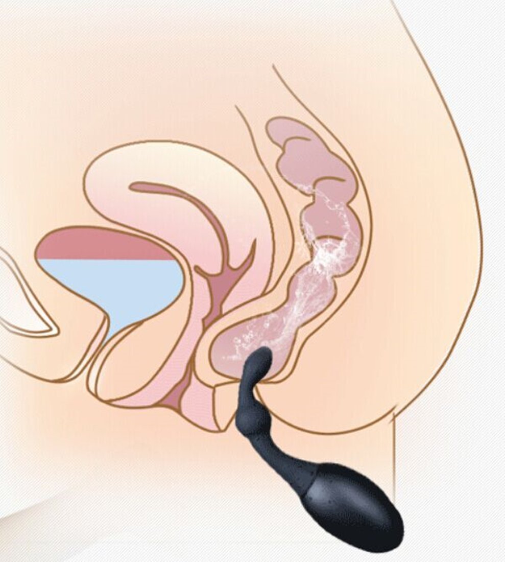 Greenpinecone Silikon Anal-Spülung,Analdusche und Vaginaldusche,Perlen Klistierspritze