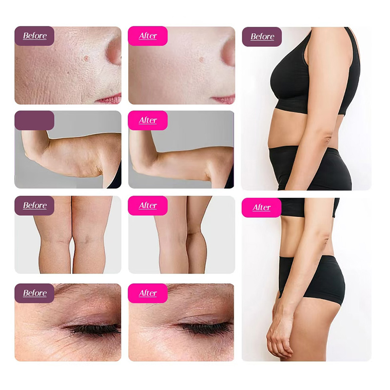 6-in-1 Cavitation Machine II | Fat Reduction, Body Contouring, Skin Tightening