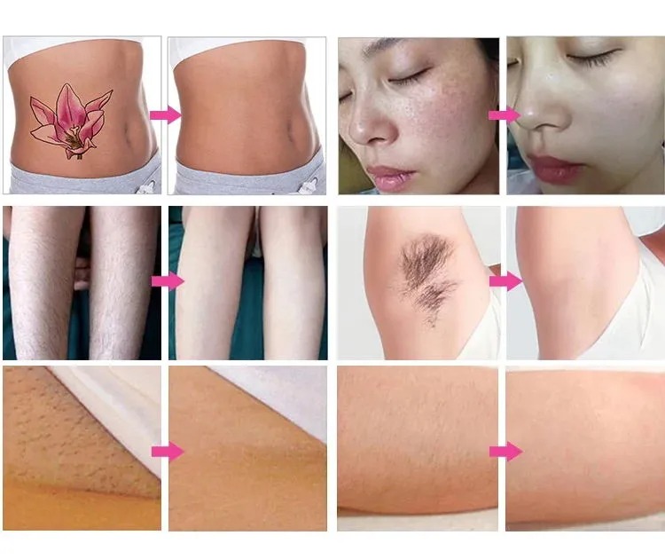 2-in-1 Portable Laser Hair & Tattoo Removal Machine: Diode Laser Hair Removal & Picosecond Laser Tattoo Removal - Professional Beauty Solution
