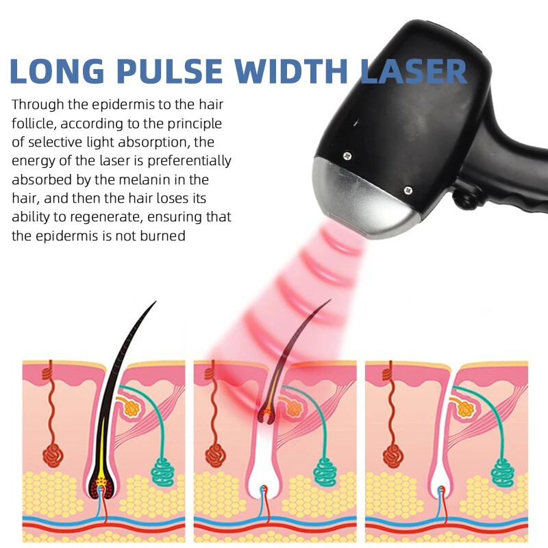 808nm Epilator Diode Laser 755 808 1064 Permanent Hair Remover Laser HairRemoval