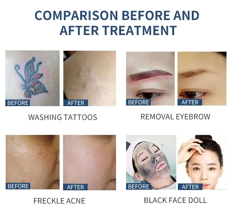 Tattoo Removal 3-in-1 OPT 360° Magneto-Optic IPL + Picosecond Laser + RF Beauty Device Fast Hair Removal Anti-Aging,& Skin Rejuvenation