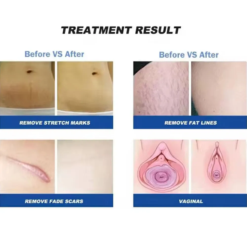 Portable Co2 fractional laser machine co2 laser cutting for vaginal tightening skin resurfacing smooth scar removal