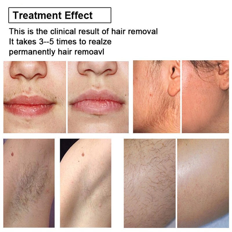Painless Laser Hair Removal Device - 808nm Diode Laser, Freezing Point Technology, Non-Invasive Hair Removal for Smooth Skin