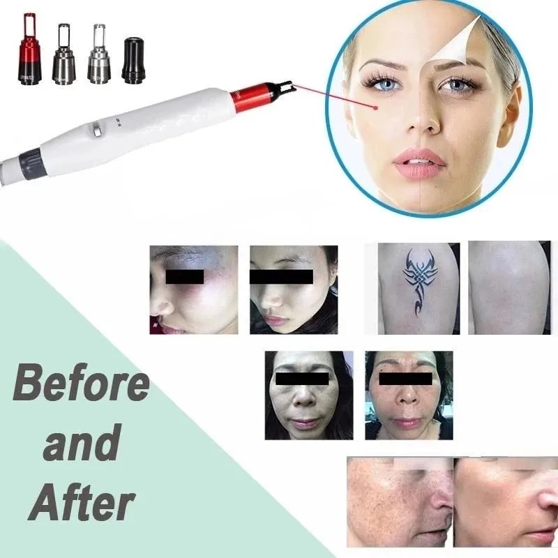 Ce Approved Q Switch ND YAG 1064/532nm Laser for Tattoo Removal/Spot Removal Machine
