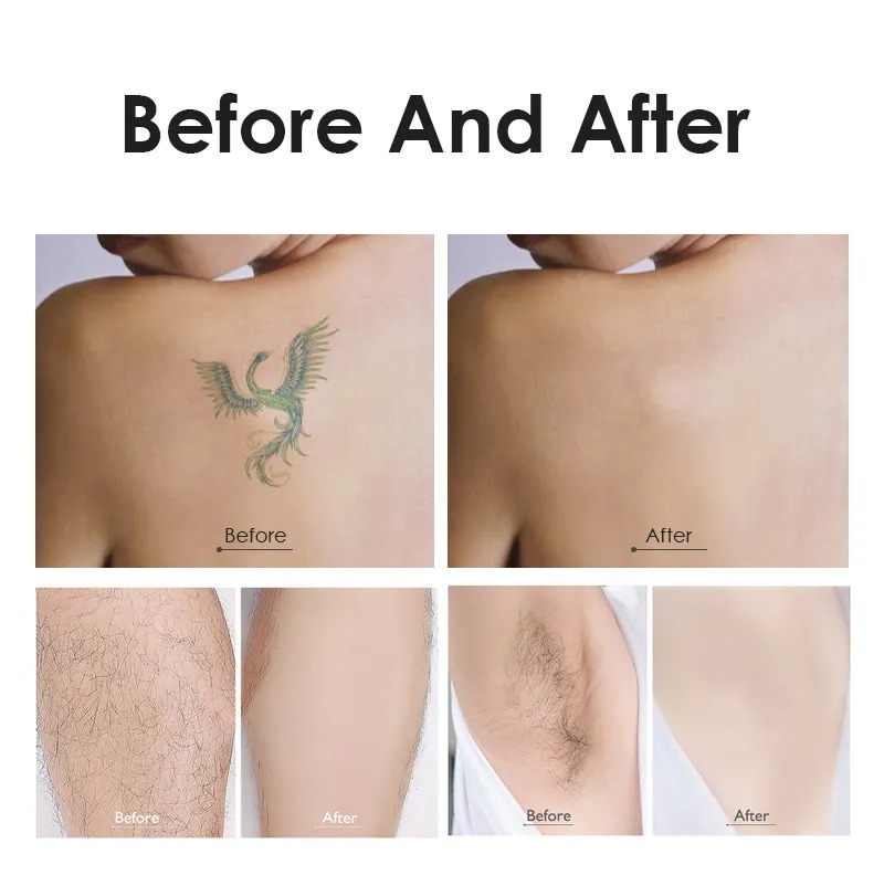 Picosecond Laser Tattoo Removal Machine & 808 Diode Laser Hair Removal - 2-in-1 Beauty Equipment