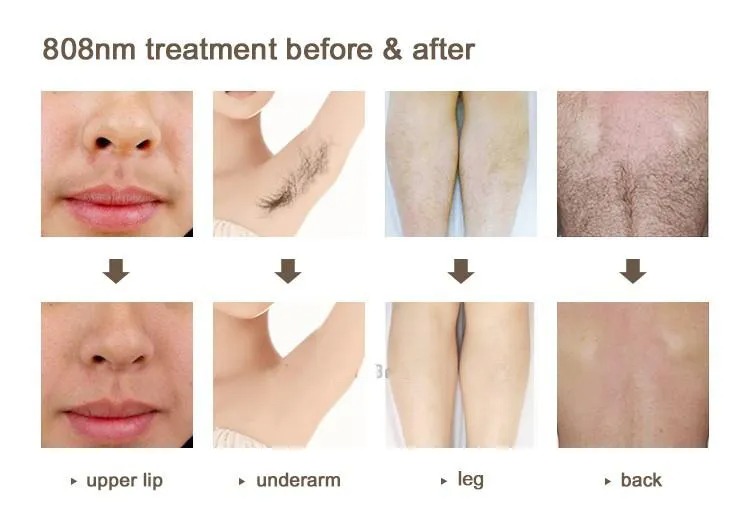 Advanced Laser Hair Removal Machines - Multi-Wavelength 808nm Diode System for Permanent Hair Reduction and Skin Rejuvenation