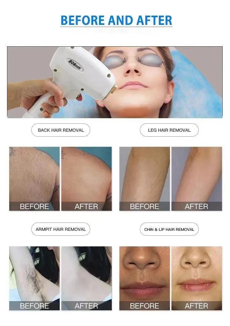 Painless Laser Hair Removal Device - 808nm Diode Laser, Freezing Point Technology, Non-Invasive Hair Removal for Smooth Skin