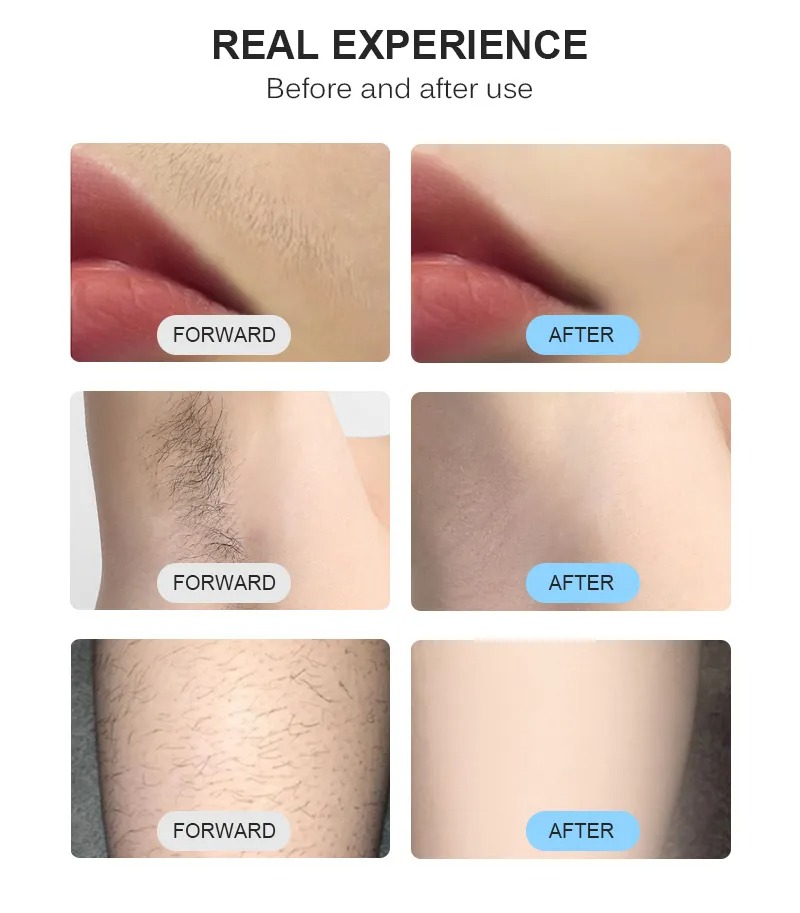 2000W Ice Platinum Diode Laser Hair Removal - 3 Wavelengths 755/808/1064nm, Painless Facial & Body Epilator, Factory Price