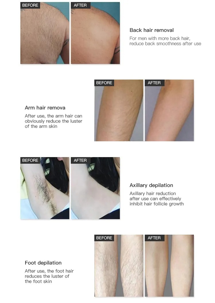 Advanced Laser Hair Removal Machines - Multi-Wavelength 808nm Diode System for Permanent Hair Reduction and Skin Rejuvenation