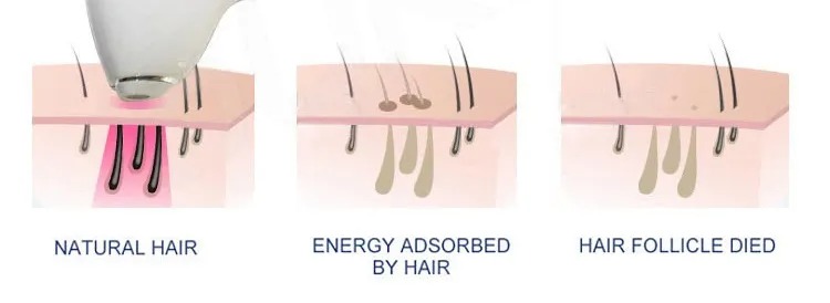Advanced Laser Hair Removal Machines - Multi-Wavelength 808nm Diode System for Permanent Hair Reduction and Skin Rejuvenation