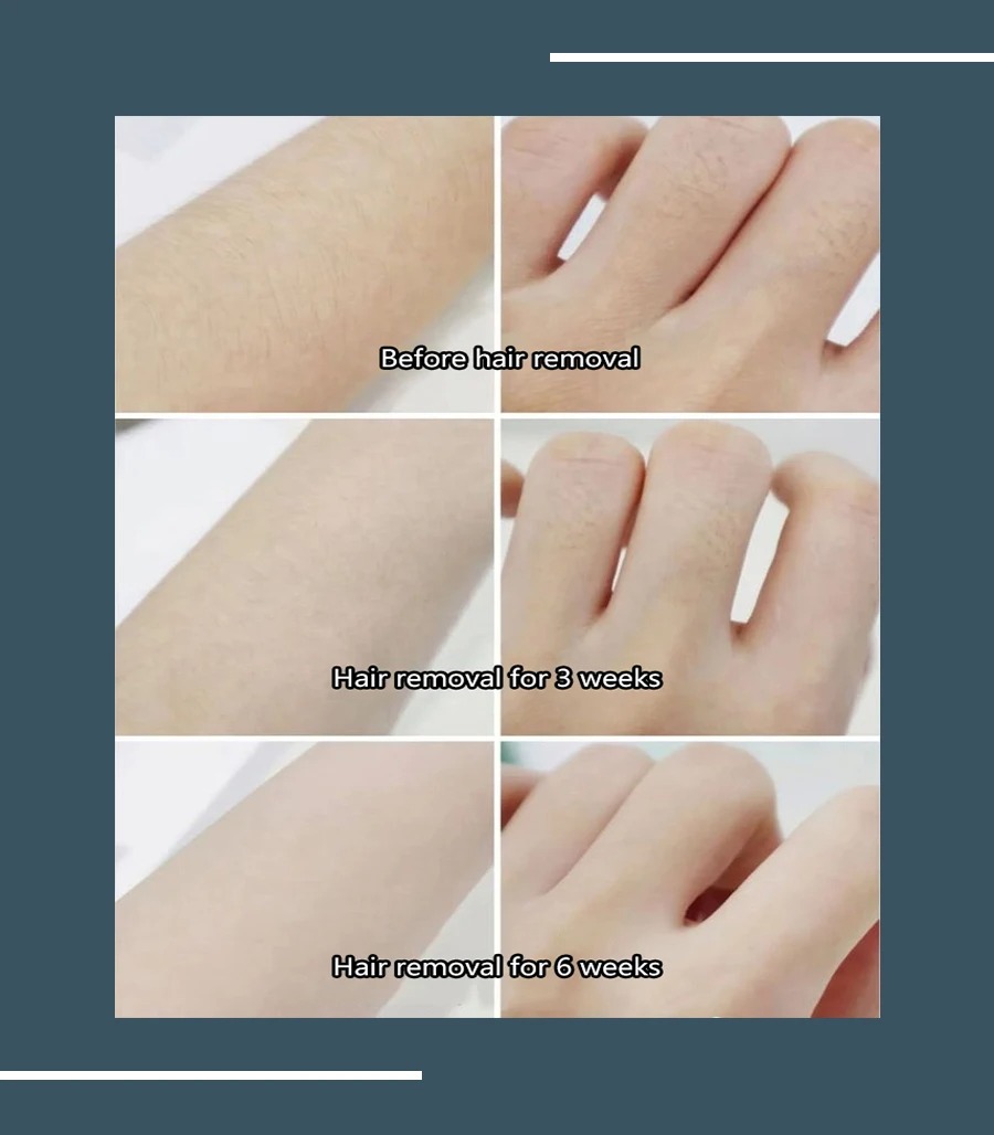 Advanced Hair Removal System: Diode Laser Technology for Effective and Gentle Skin Treatment - 755 808 1064 nm Wavelength Precision