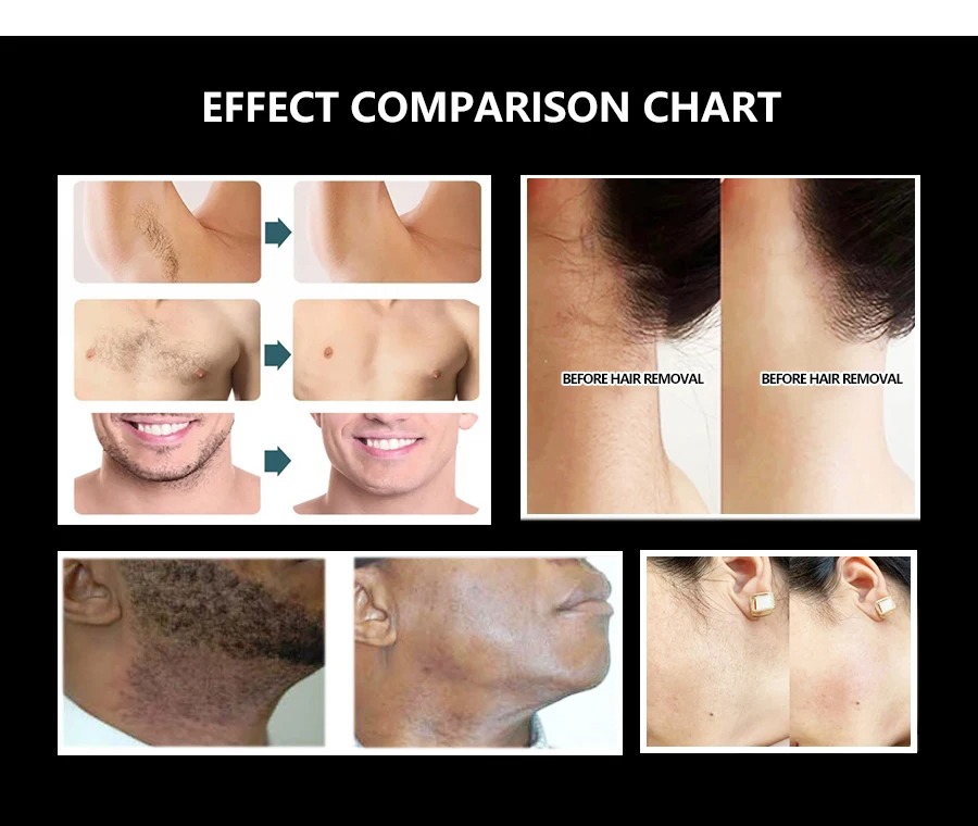 Advanced Hair Removal System: Diode Laser Technology for Effective and Gentle Skin Treatment - 755 808 1064 nm Wavelength Precision