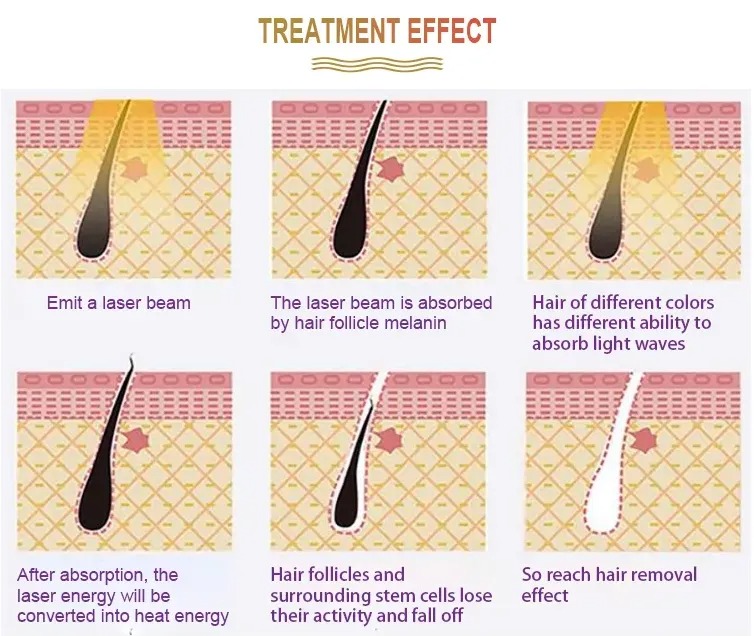 3 Wavelengths 808nm Diode Laser Epilator - Painless Hair Remover & Skin Rejuvenation Machine