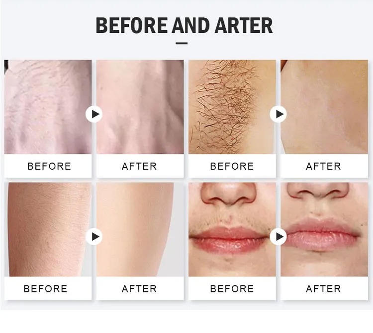 3 Wavelengths 808nm Diode Laser Epilator - Painless Hair Remover & Skin Rejuvenation Machine