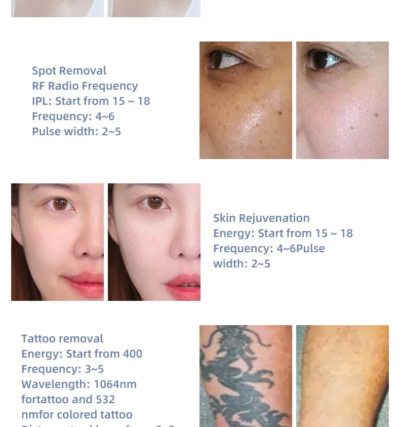 Tattoo Removal Machine Laser Hair Removal Machine 3 in 1 Vertical nd Yag Permanent OPT Ipl Shr Hair Removal