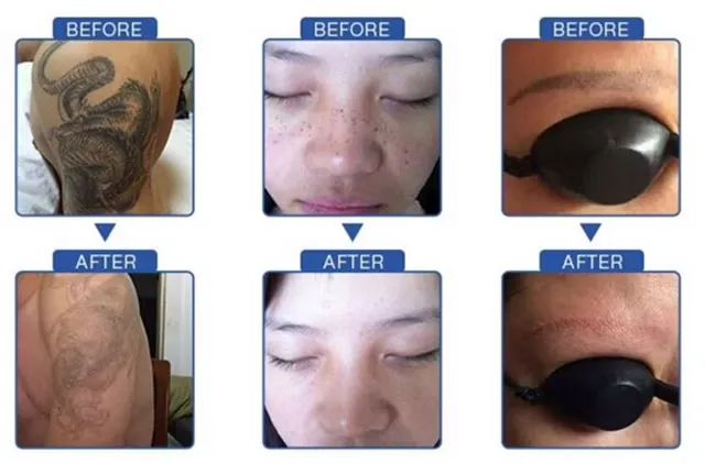 Professional Black Doll Treatment Tattoo Freckle Birthmarks Removal ND YAG Laser Machine