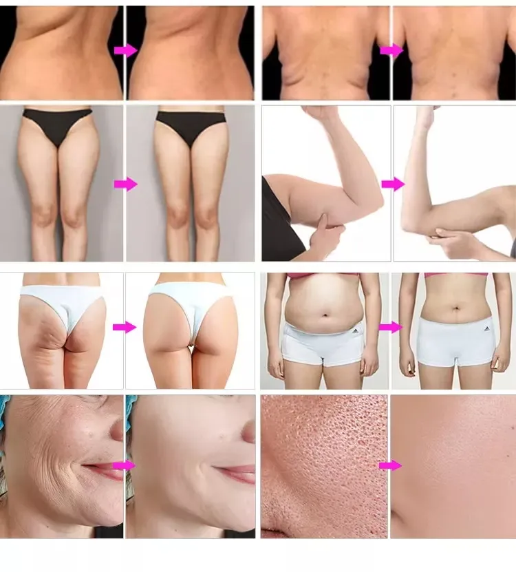 Portable Liposuction Kim 9 in 1 RF 40K Cavitation Lipolaser Slimming Machine