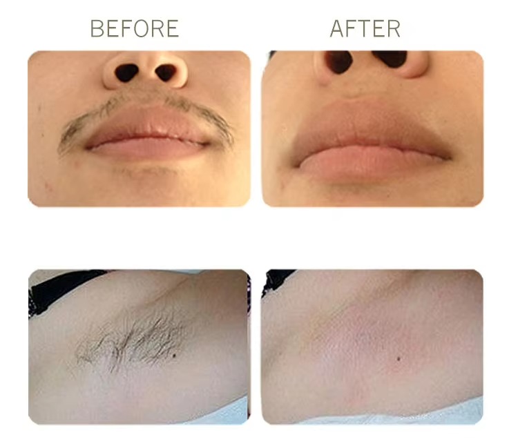 IPL DPL SHR Hair Removal Acne Freckle Removal Skin Rejuvenation Beauty Machine