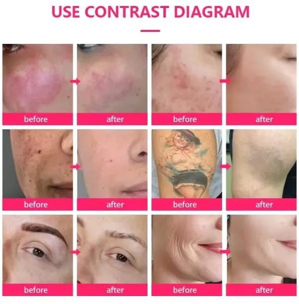 Picosecond Tattoo Removal Machine with Nd:YAG Laser