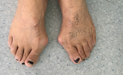 拇指外翻何进行治疗?