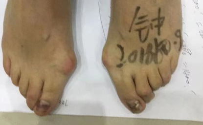 拇指外翻的原因