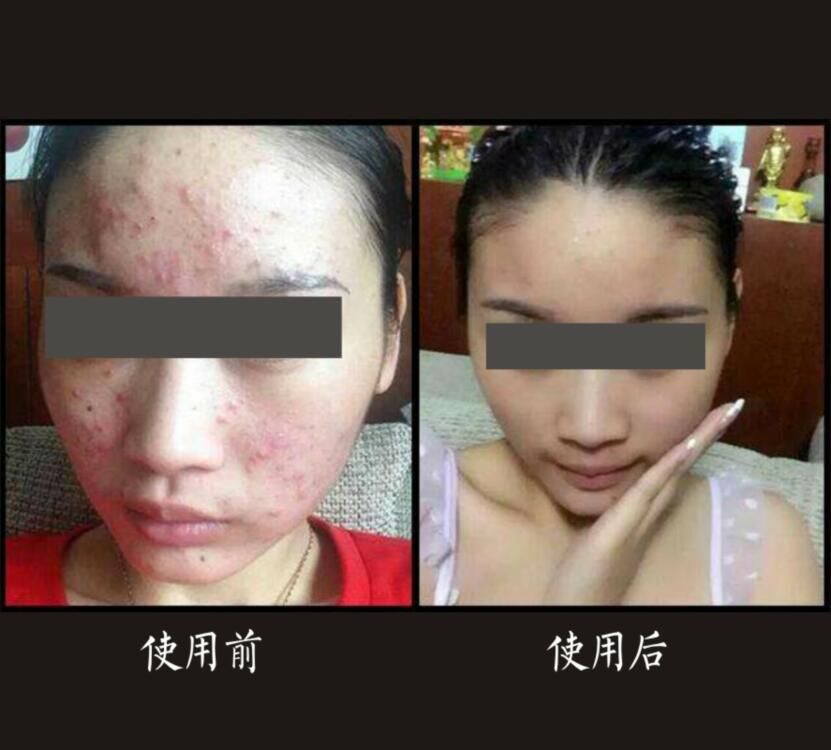 左旋VC亮肤精华液与多效修护肽精华液治疗痘印的使用效果