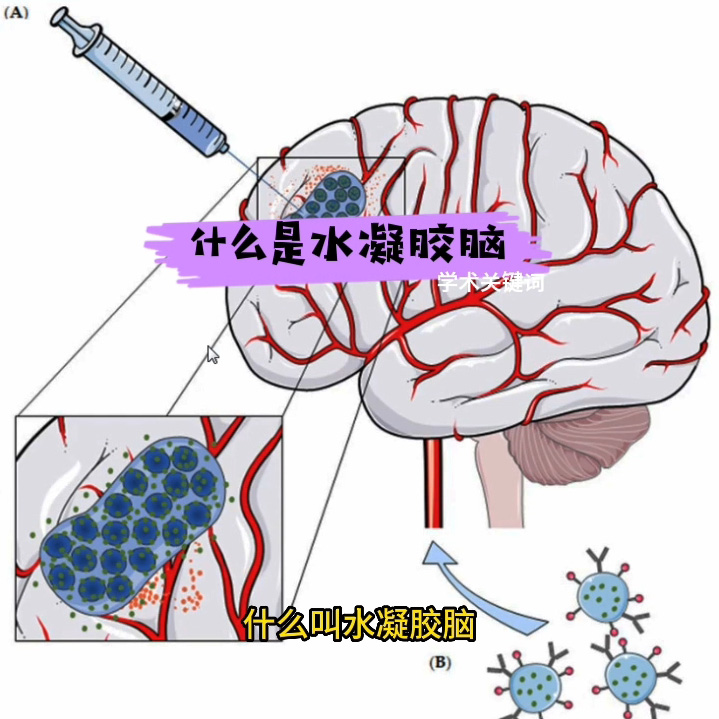 什么是水凝胶脑-2023