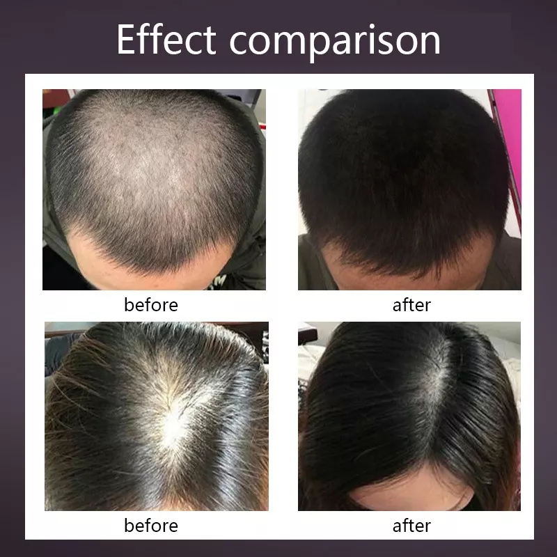 Hair Growth Spray – Herbal Anti-Hair Loss Serum for Fast Hair Regrowth & Scalp Nourishment