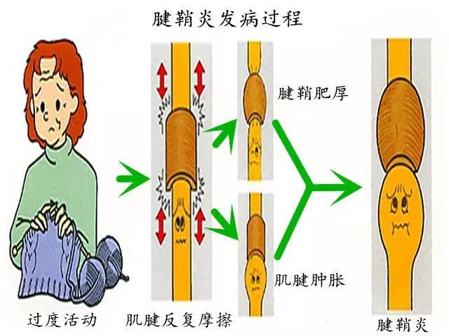 康骨堂 哪些信号提醒我们患了骨关节炎？