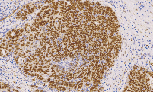 Wlims Tumer鼠抗人肾母细胞瘤单克隆抗体