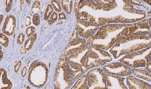 Alpha-Methylacyl-CoA Racemase(AMACR,p504s)鼠抗人a-甲基酷基辅酶A消旋酶单克隆抗体