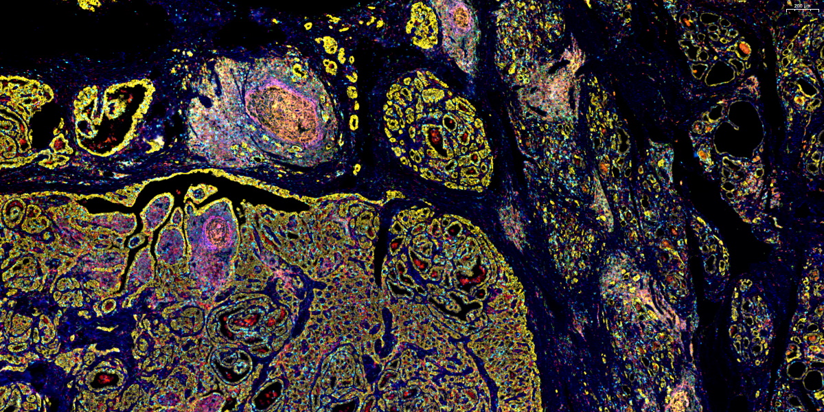 6标7色-乳腺-浸润性小叶癌