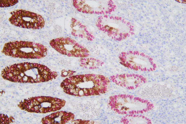 高分化结肠癌SATB2+CK20