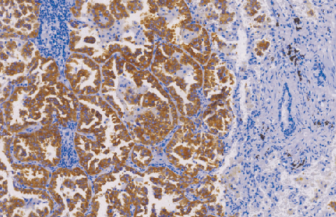 Anaplastic Lymphoma(ALK)(CD246)(p80)鼠抗人间变性淋巴瘤激酶单克隆抗体