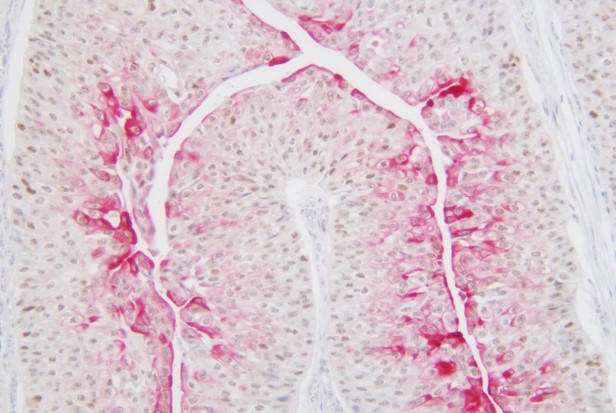 低级别尿路上皮癌CK20+P53