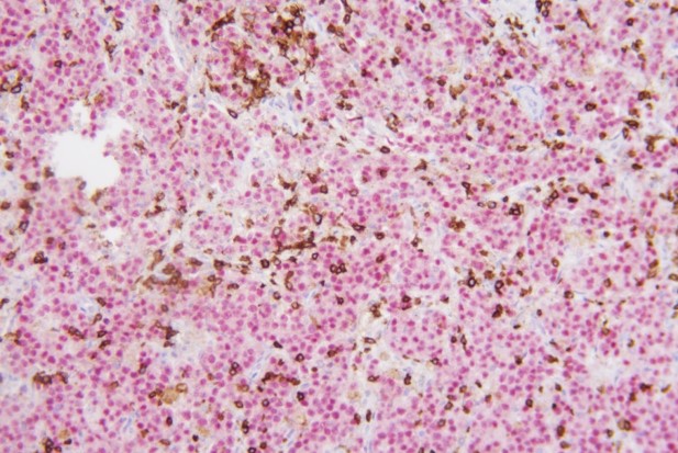 PAX5+CD3  弥漫性B细胞淋巴瘤