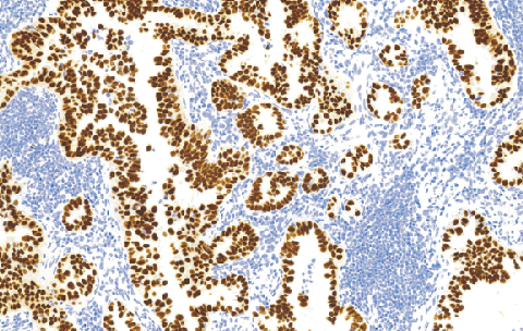 Thyroid Transcription Factoc-1(TTF-1)鼠抗人甲状腺转录因子(TTF-1)单克隆抗体