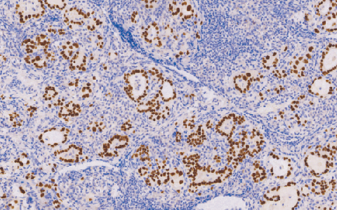 Thyroid Transcription Factoc-1(TTF-1)鼠抗人甲状腺转录因子(TTF-1)单克隆抗体