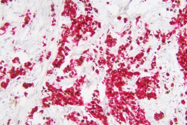 浸润性尿路上皮癌-CK20+P53