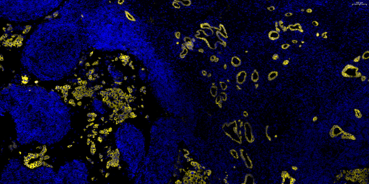 780-CK-肺非小细胞癌-10X