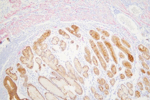 结肠癌CKpan+Desmin