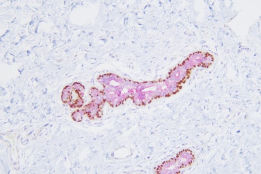 乳腺CK7+Calponin+P63