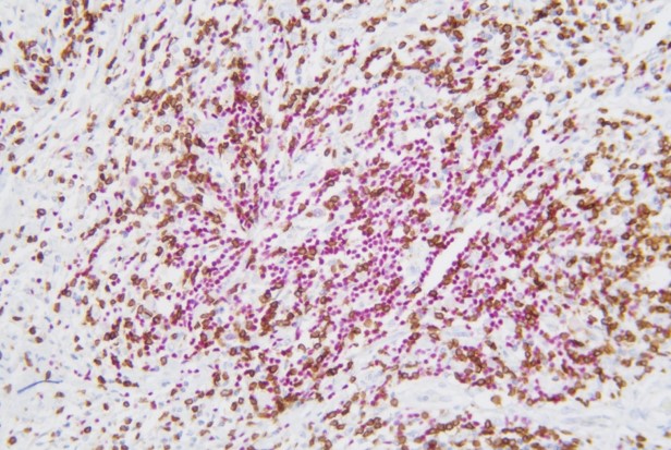 PAX5+CD3  霍奇金淋巴瘤