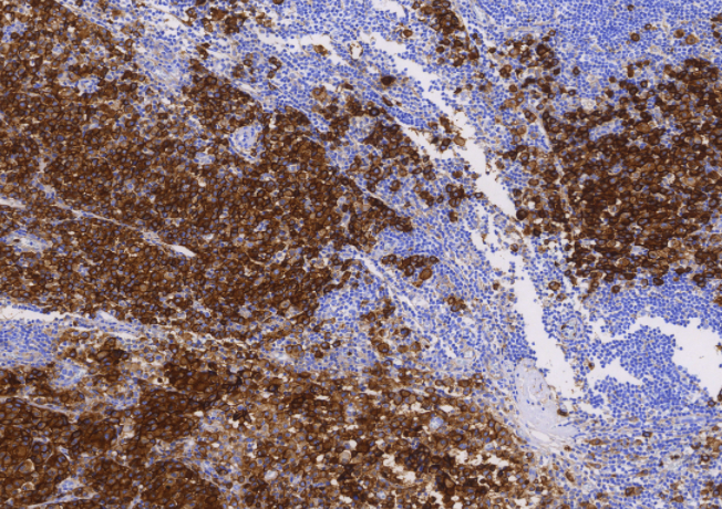 CD63  恶性黑色素瘤