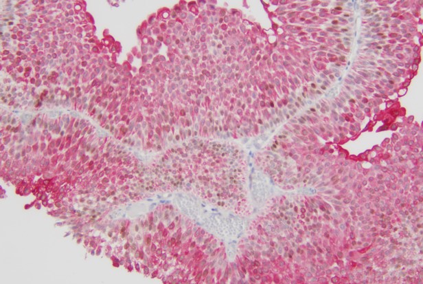 高级别乳头状尿路上皮癌CK20+P53