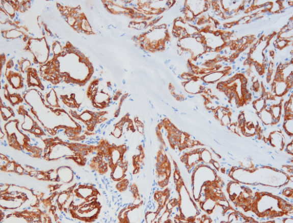 术中快速冰冻免疫组化