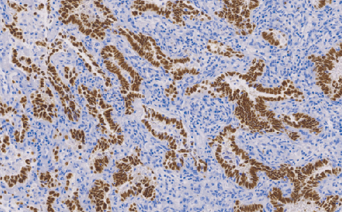 Thyroid Transcription Factoc-1(TTF-1)鼠抗人甲状腺转录因子(TTF-1)单克隆抗体