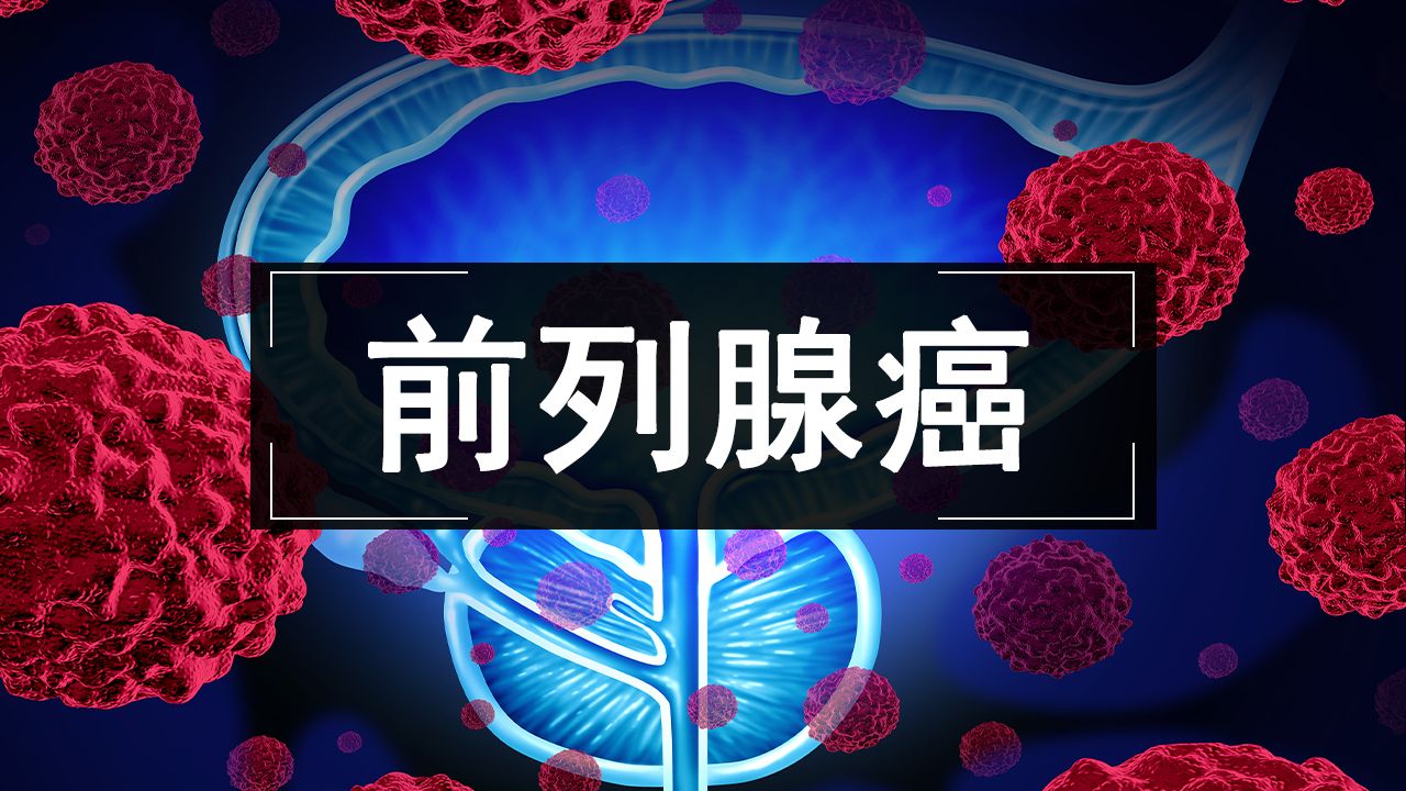 361. EZH2抑制剂治疗既往醋酸阿比特龙治疗失败的转移性去势抵抗性前列腺癌的临床招募