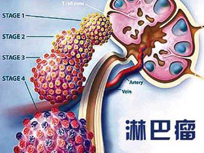 復發或難治性外周T細胞淋巴瘤患者的臨床招募