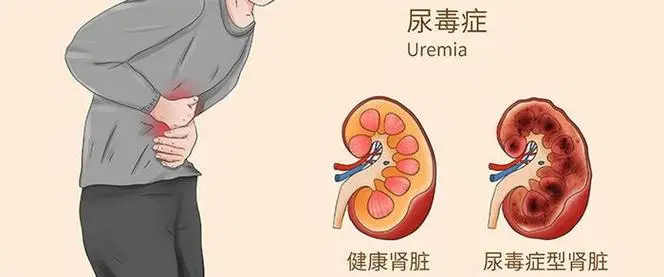 尿毒症盯上年轻人？这些习惯正在悄悄毁掉你的肾